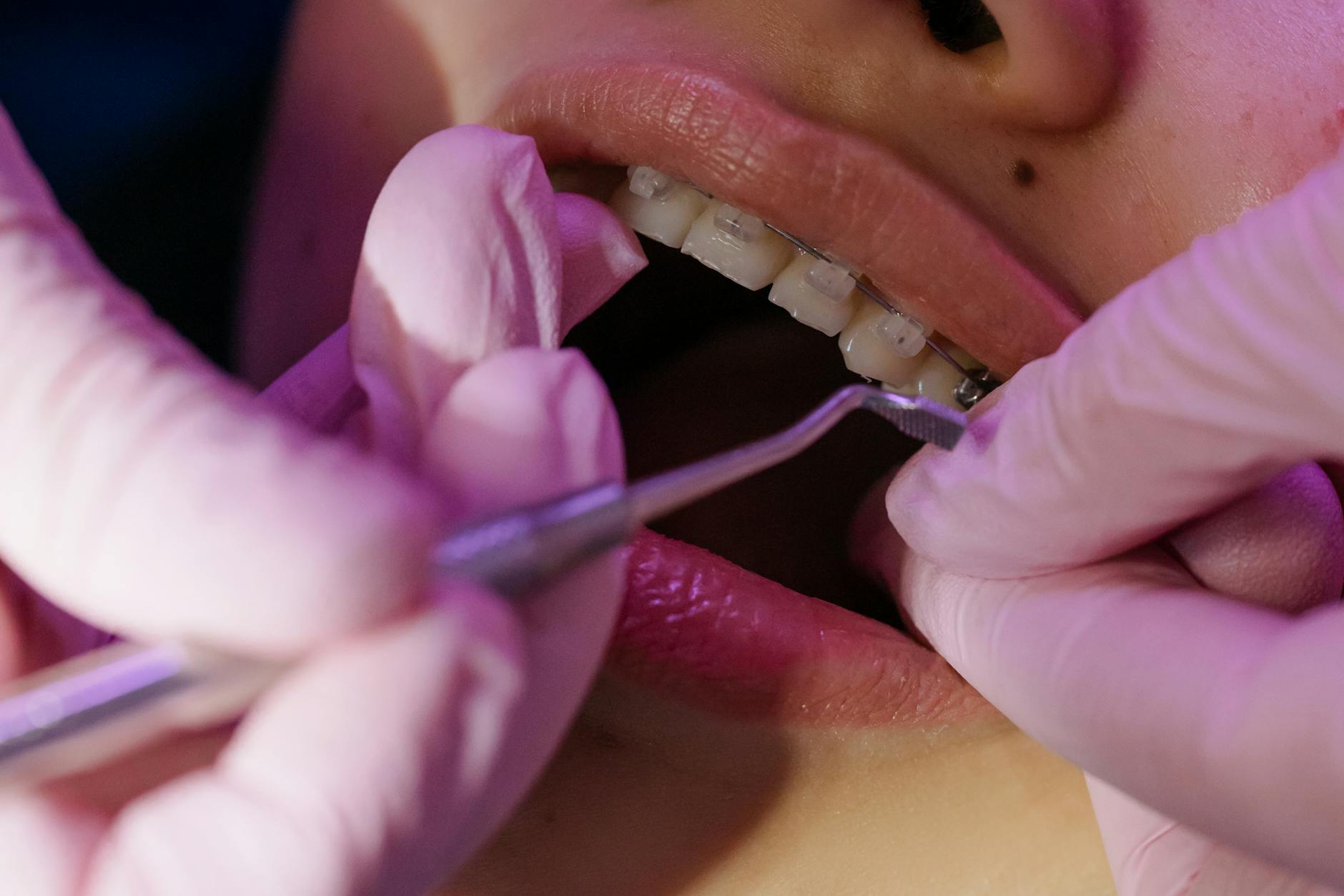 treating of a teeth with braces